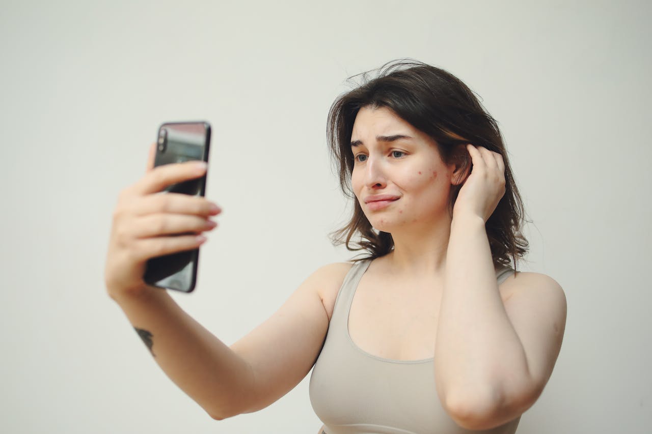 Understanding the causes of acne — hormones, diet and more