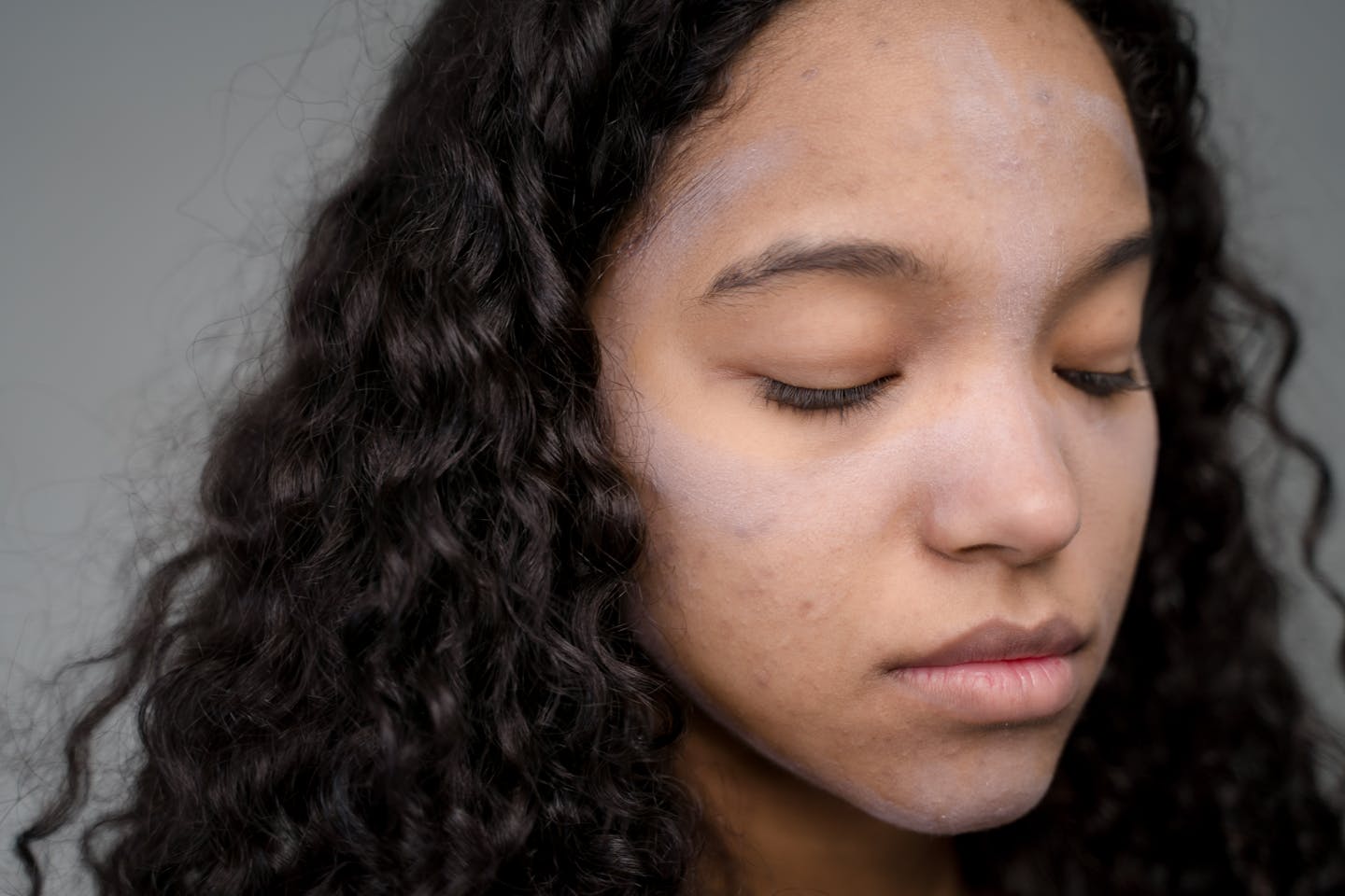Dealing with acne scars